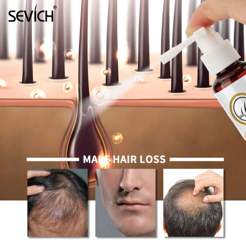 Sevich Anti Hair Loss Essential Oil 50ml