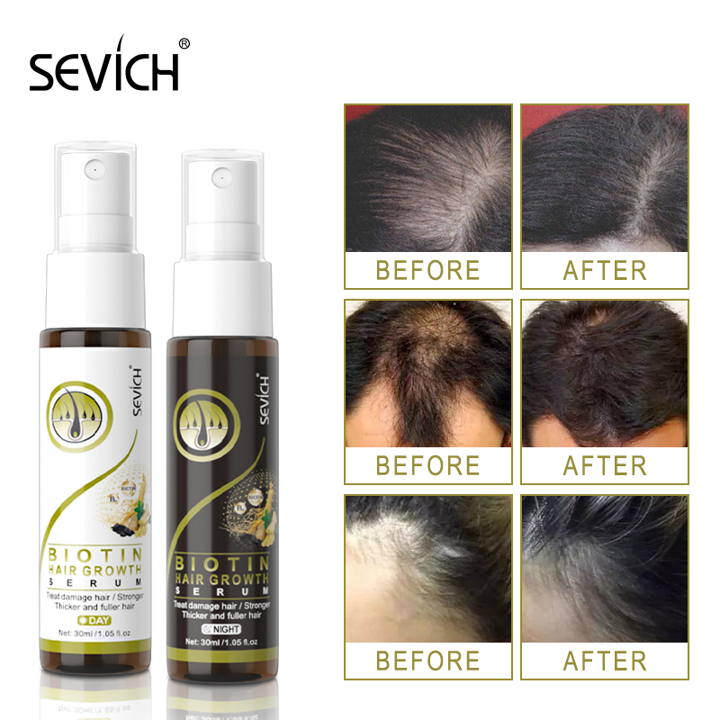 Sevich Day& Night Biotin Fast Hair Growth Serum Spray Set Ginger ...