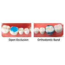 ORTHOBOND Light Cure Orthodontic Adhesive Intro Kit (Blue)