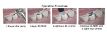 DX.TEMP Dental temporary light cure composite 2.5g/Syringe Blue Color