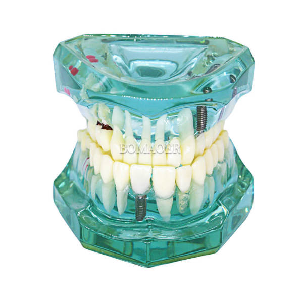 Dental Tooth Study Dentist Implant Disease Teeth Model with Restoration & Bridge