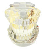 dental implant model, bridge pathology, dental veneer restoration, m2001 with nerve (yellow)