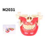 M2031 Mini Screw Practice Model, Dental Anchorage Training Model