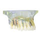 Transparent Maxillary Sinus Implant Model, Osteoporosis Dental Oral Model M2015