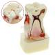 4X Magnified Dental Caries Model