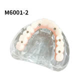 Maxillary Implant Restoration Model M6001-2