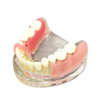 Dental Restoration Model M6006