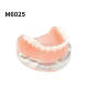 Maxillary Implant Restoration Model M6025 Dental Teaching Typodont