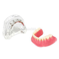 Dental Restoration Model M6008 Dental Implant Comparison Typodont Model