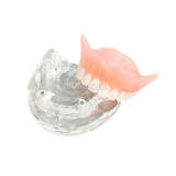Maxillary Implant Restoration Model M6025 Dental Teaching Typodont