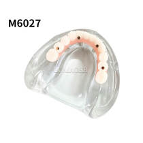 Maxillary 2 Root Implants Overdenture Restoration Model M6027