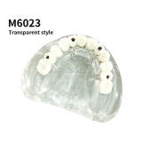 Transparent Maxillary Implant Restoration Model M6023