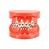 Malocclusion Correction Model with Brackets Red Orthodontic Demo Model M3005
