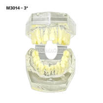 #3 Transparent Malocclusion Orthodontic Model Single Type Teaching Display M3014