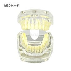 Transparent Malocclusion Correction Demonstration Model M3014 No.1