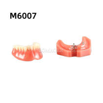 Transparent Mandible Implant Position Direction Typodont Model Denture Restoration Demo (M6007)