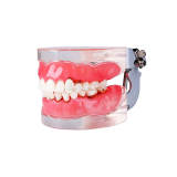 Periodontal Disease Model M4017, Removable Gingiva & Dental Calculus, Dental Teaching Typodont