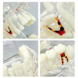 Transparent Mixed Dentition Model M7015, Kids Primary & Permanent Teeth Transition Dental Teaching Typodont