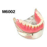 M6002 Dental Implant Overdenture Restoration Teaching Model