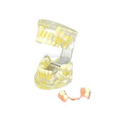 M7019 Pediatric Mixed Dentition Model Early Primary Tooth Loss & Space Maintainer Demonstration Typodont