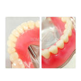 M6002 Dental Implant Overdenture Restoration Teaching Model