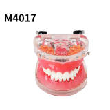 Periodontal Disease Model M4017, Removable Gingiva & Dental Calculus, Dental Teaching Typodont