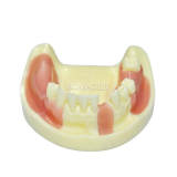 Yellow Mandibular Dental Implant Practice Model
