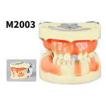 M2003 Yellow Full Arch Dental Implant Practice Typodont Model