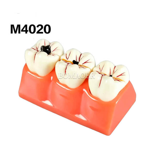 4-fold caries decomposition model M4020