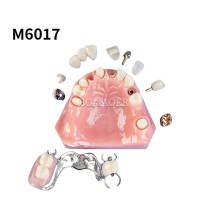 Implant restoration model m6017