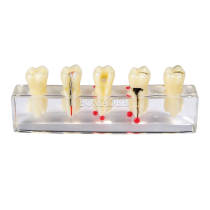 root canal treatment model, common intraoral model, dental caries model and root canal filling m4012