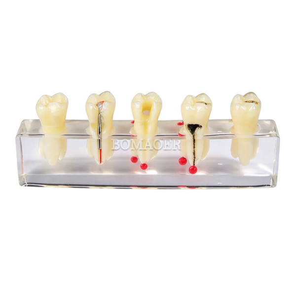root canal treatment model, common intraoral model, dental caries model and root canal filling m4012